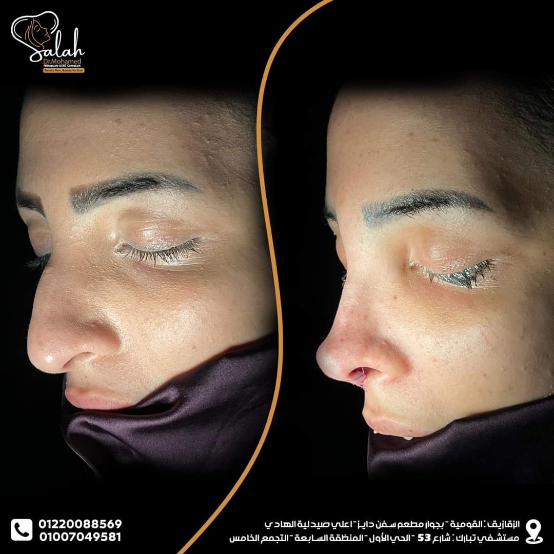 Droopy Tip Rhinoplasty